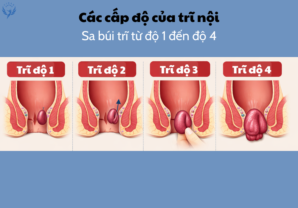 Phân biệt trĩ độ 1 độ 2 độ 3 độ 4 dựa trên mức độ sa búi trĩ
