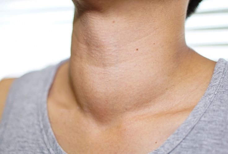 bướu cổ là biểu hiện của suy giáp