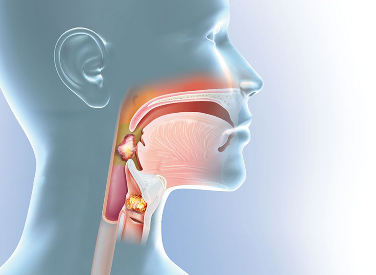 Trẻ bị chảy mũi, dịch chảy xuống họng gây ho, nhất là về đêm